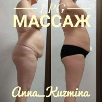 Лот: 10274798. Фото: 3. LPG массаж тела, кавитация, RF-... Услуги