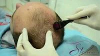 Лот: 3819279. Фото: 5. Миноксидил киркланд 5% (minoxidil...