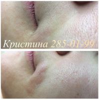 Лот: 2316112. Фото: 6. Электроэпиляция. Микропигментирование...