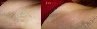Лот: 3139642. Фото: 5. Электроэпиляция - удаление волос...