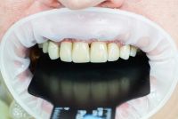 Лот: 19707869. Фото: 4. Стоматологические услуги по бартеру. Красноярск