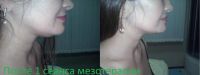 Лот: 2385348. Фото: 6. Похудение LPG массаж,Вакуумная...