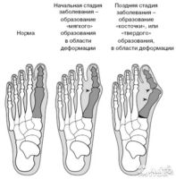 Лот: 4521013. Фото: 5. Valgus Pro (фиксатор для коррекции...