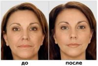 Лот: 1482135. Фото: 11. Шеллак, плазмолифтинг лица, кожи...