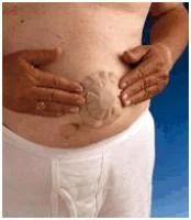 Лот: 7168567. Фото: 6. Coloplast Alterna Conseal / Алтерна...