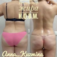 Лот: 10274798. Фото: 2. LPG массаж тела, кавитация, RF-... Красота, здоровье, медицина
