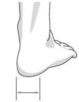 Лот: 10564005. Фото: 3. MalleoLoc® (МалеоЛок) - ортез... Красота и здоровье