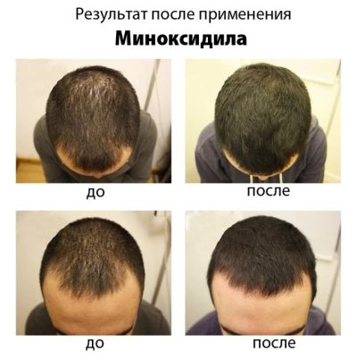 Лот: 8540757. Фото: 1. Миноксидил 5% Начинаешь лысеть... Антисептики, защитные средства, медицинские маски