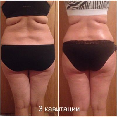 Лот: 9258170. Фото: 1. Ультразвуковая кавитация, радиочастотный... Массажеры