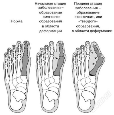 Лот: 1778583. Фото: 1. Средство от выпирающих костяшек... Другое (медицина)