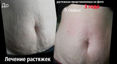 Лот: 3206504. Фото: 1. Лечение растяжек , увеличение... Другие (красота, здоровье, медицина)